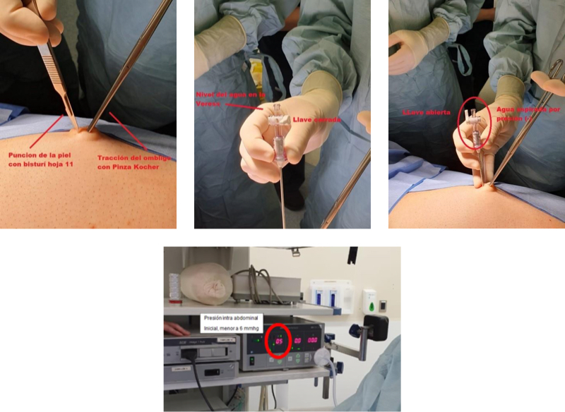 Fig. 8 Técnica de realización del pneumoperitoneo